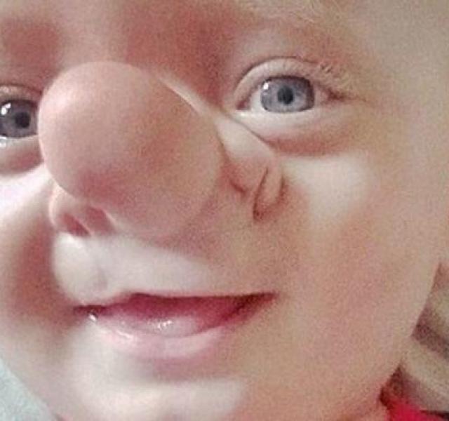 Az élő Pinokkió - különös születési rendellenességgel jött világra ez a kisfiú Pinokkió orrú kisbaba
